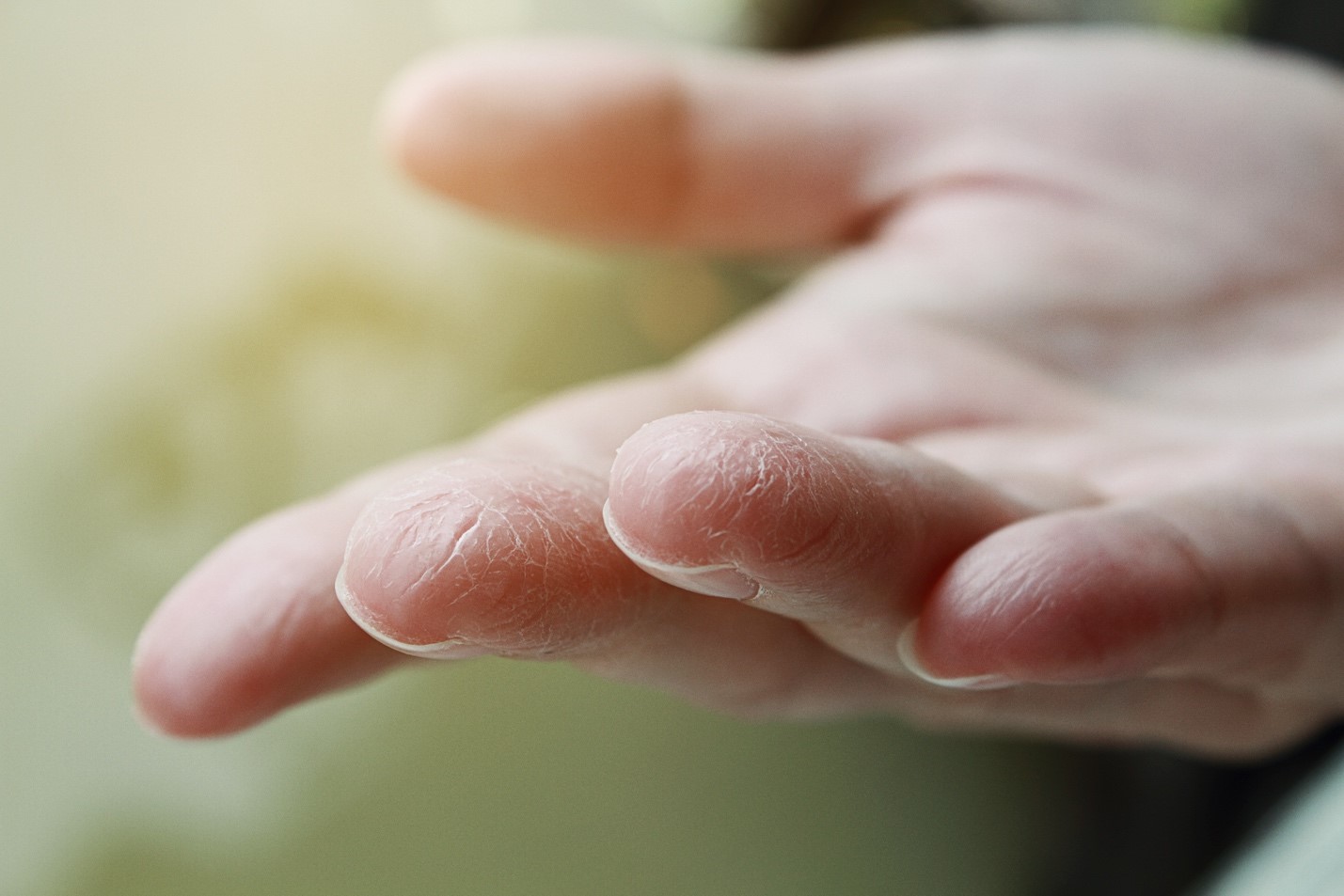 Apakah Kandungan Pewangi Hand Sanitizer Bisa Sebabkan Kulit Kering dan Iritasi?