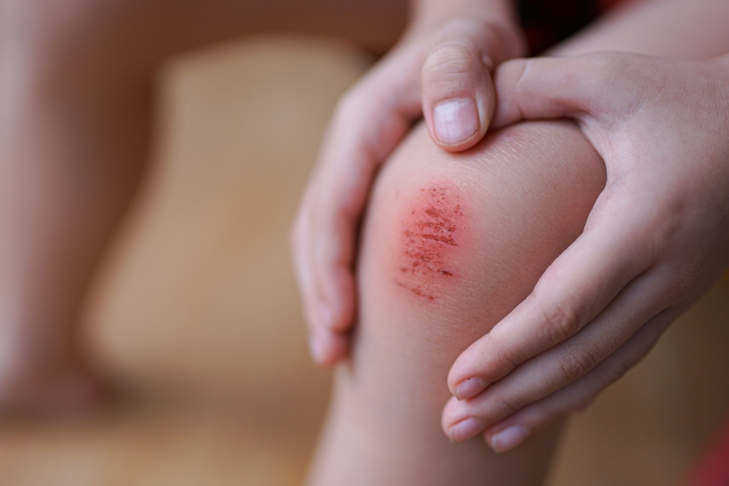 Cara Tepat Membersihkan Luka Jatuh dengan Cairan Antiseptik Pembersih Luka